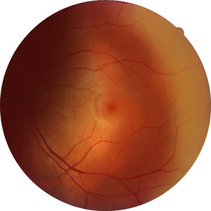 ocular Lymphoma.jpg
